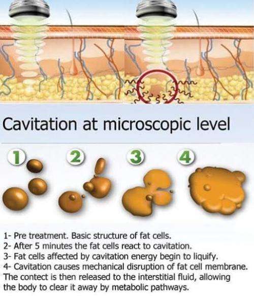Ultrasonic Cavitation Machine