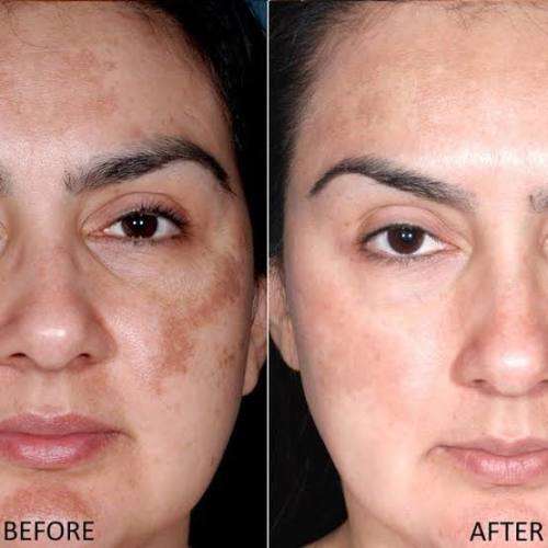 Kojic Acid Powder 99%