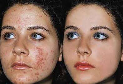 Kojic Acid Powder 99%