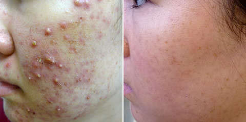 Snail Gel Clay  50ml  by SoOrganic. Wrinkles, Blemishes, pigmentation, acne, eczema, psoriasis etc..