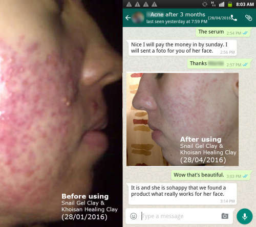 Snail Gel Clay  50ml  by SoOrganic. Wrinkles, Blemishes, pigmentation, acne, eczema, psoriasis etc..