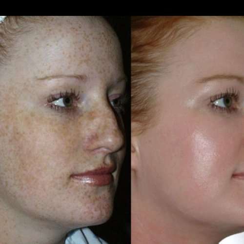 Anti-aging Chemical Face peel - Lactic acid 50% strength