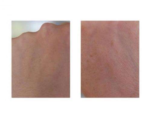 Anti-aging Chemical Face peel - Lactic acid 50% strength