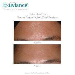 Chemical peel - 25% Neostrata Exuviance