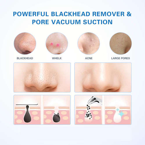 Electric Vacuum Pore Cleaner Blackhead Remover-White Unboxed