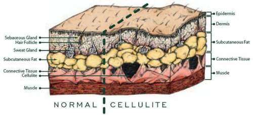 Cellulite Package