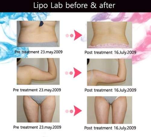 Lipo Lab Fat Dissolving Injections: The Original LipoLab- 1x10ml Lipolysis Injection Vial-