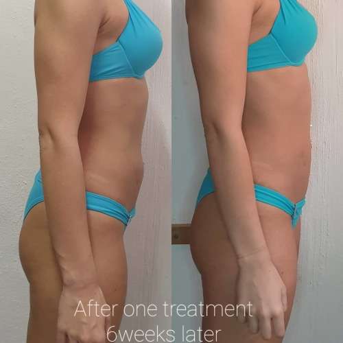 Lipo Lab Fat Dissolving Injections: The Original LipoLab- 1x10ml Lipolysis Injection Vial-