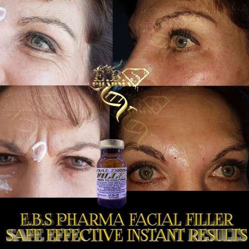 Facial FillerEbs Pharma Sa Facial Filler100 Unit Syringe
