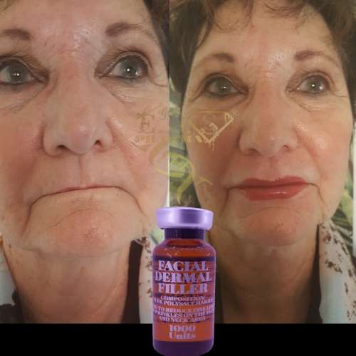 Facial FillerEbs Pharma Sa Facial Filler100 Unit Syringe