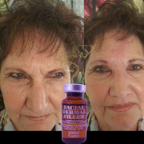 Facial FillerEbs Pharma Sa Facial Filler100 Unit Syringe