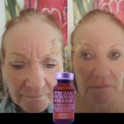 Facial FillerEbs Pharma Sa Facial Filler100 Unit Syringe