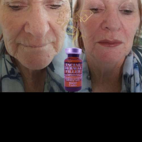 Facial FillerEbs Pharma Sa Facial Filler100 Unit Syringe