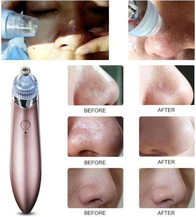 Electric Vacuum Blackhead Remover