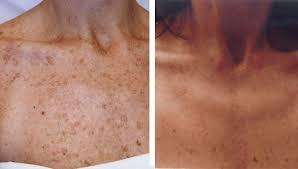 #1 Skin Whitening Glutathione SPF50++ cosmetic soap 70g.Pure Gluta,Vit B3+E+C,rice milk.NO lye.