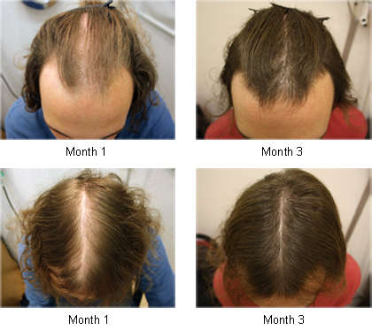 #1 Ginger Strong hair regrow shampoo  DHT hormone blocker.Gray hair natural reversal.200ml