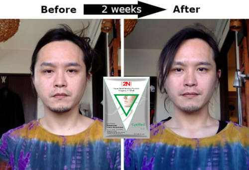 1pcs 2N V-face mask. 1cm Lifting in 1 treatment.Whitening,reduction double chin,skin tightening