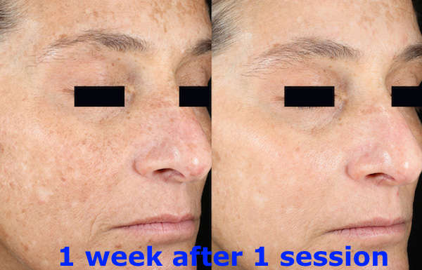 #1 picosecond laser skin spot removal mobile session freckles scars,acne tattoosJHB only NOT DEVICE.