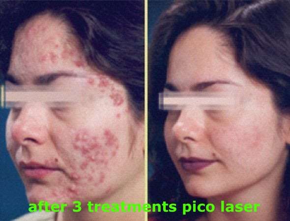 #1 picosecond laser skin spot removal mobile session freckles scars,acne tattoosJHB only NOT DEVICE.