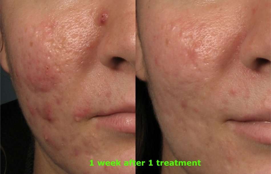 #1 picosecond laser skin spot removal mobile session freckles scars,acne tattoosJHB only NOT DEVICE.