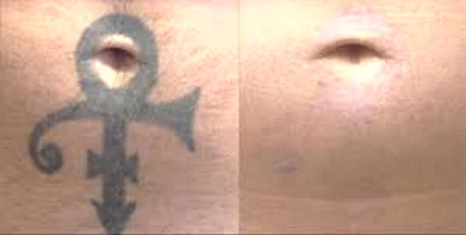 #1 picosecond laser skin spot removal mobile session freckles scars,acne tattoosJHB only NOT DEVICE.