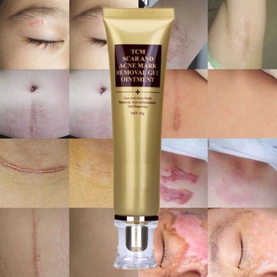 TCM skin scar & acne marks removal gel oitment.30g. anti-inflamatory repair .