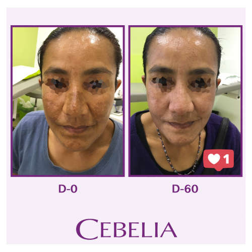 CEBELIA REINFORCED DEPIGMENTING SERUM