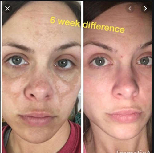 Ultra-Potent Skin Lightening Serum (Admire my Skin) 30 ml For Hyperpigmentation, Melasma, Dark Spots