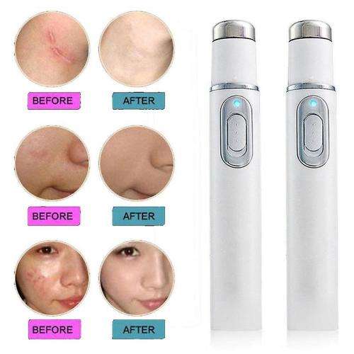 Blue Light Therapy Acne Laser Pen