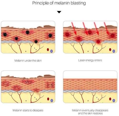 Professional Laser Picosecond Pen Blue Light Therapy Tattoo and Spot Removal