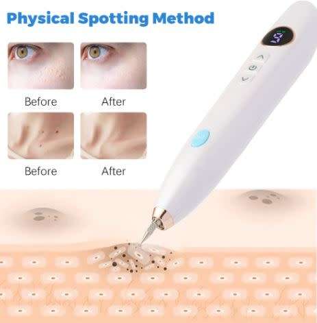 Laser Plasma Mole/Freckle/Skin tag/Wart Removal Pen