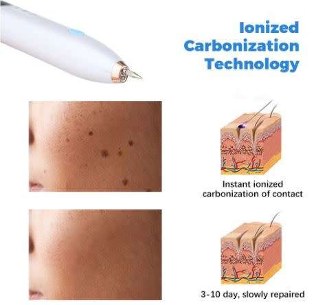 Laser Plasma Mole/Freckle/Skin tag/Wart Removal Pen