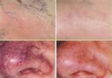 Laser Therapy Device: Scars-Wounds-Hair Growth- Wrinkles-Blemishes-Acute Pain