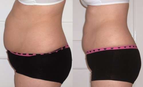 Four laser lipo sessions