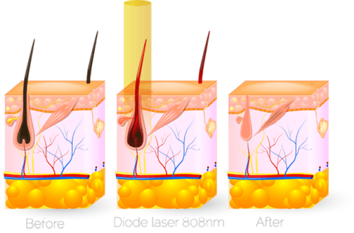 6 Sessions of Laser Hair Removal @ Brazen Beauty Bar