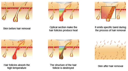 6 Sessions of Laser Hair Removal @ Brazen Beauty Bar