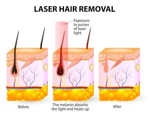 6 Sessions of Laser Hair Removal @ Brazen Beauty Bar