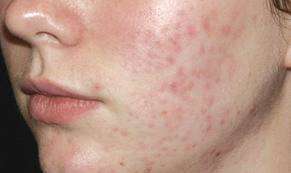 The Miracle Healer   AFRICAN POTATO CREAM!