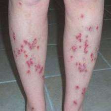 DERMAHEAL for Healing of all septic skin conditions.