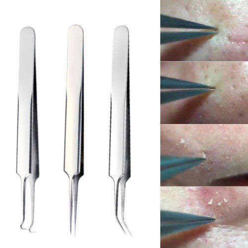 Blackhead Remover Tool Whitehead Pimple Acne Blemish Comedone Extractor