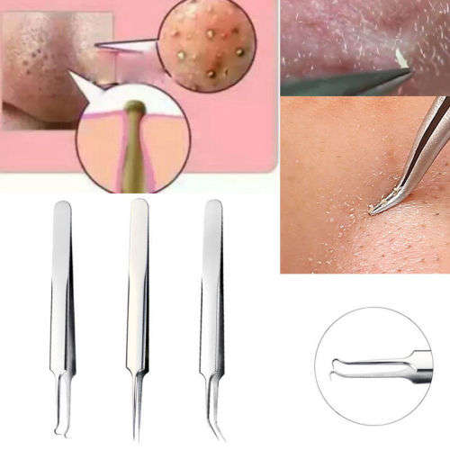 Blackhead Remover Tool Whitehead Pimple Acne Blemish Comedone Extractor