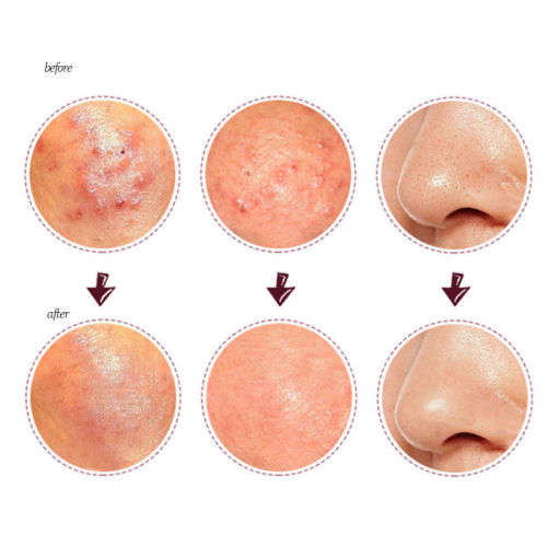 Blackhead Remover Tool Whitehead Pimple Acne Blemish Comedone Extractor