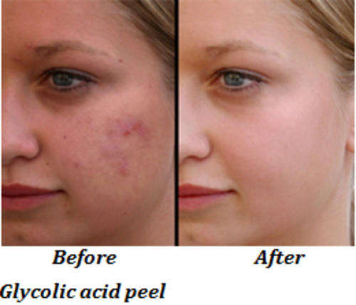 * 50% STRENGTH GLYCOLIC SALON CHEMICAL PEEL AT HOME! *