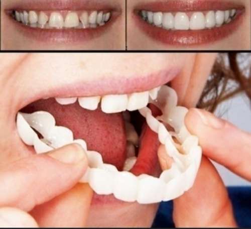 Instant snap on smile mold