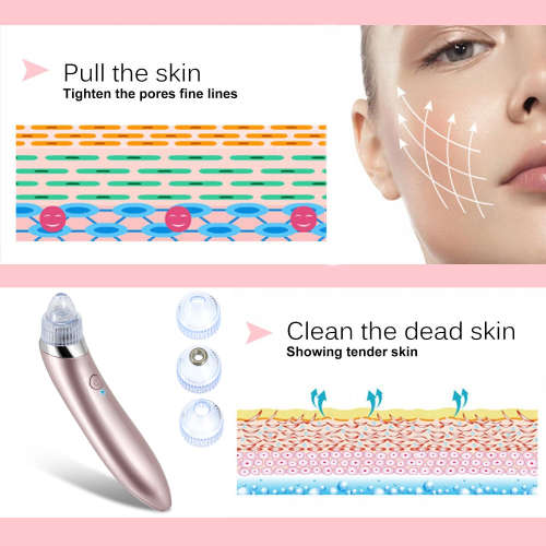 ELECTRIC BLACKHEAD REMOVER....WORKS LIKE A PRO!