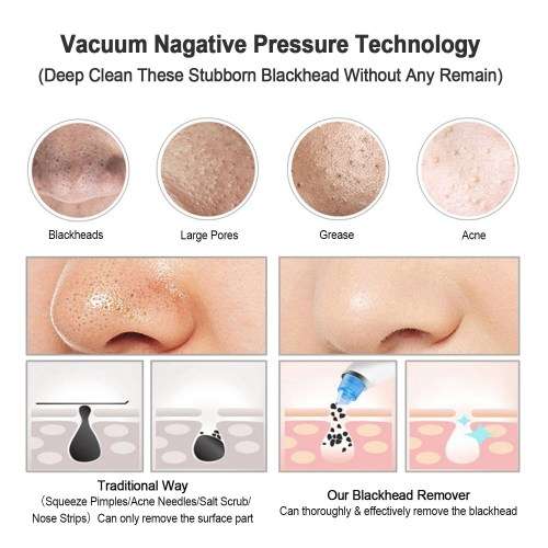 ELECTRIC BLACKHEAD REMOVER....WORKS LIKE A PRO!