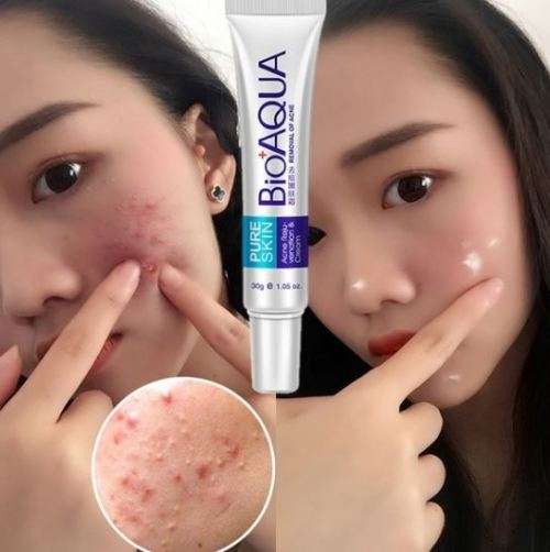 Face Anti Acne Scar Remove Cream