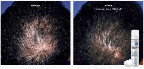 Rogaine x1 month