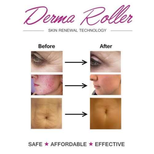 4 in 1 Skin-Care Micro Needle Derma Roller Facial Massager Anti Aging Therapy