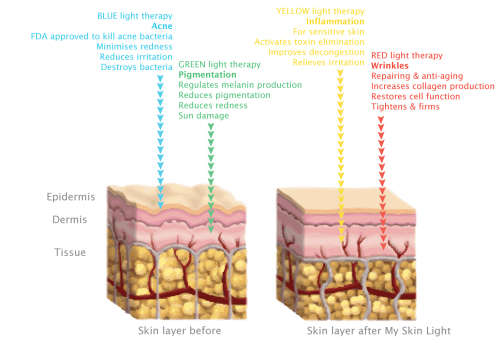 Blue & red light skin therapy devices at cost